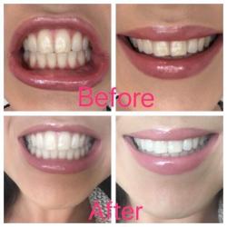 Teeth Whitening Toothpaste ????.